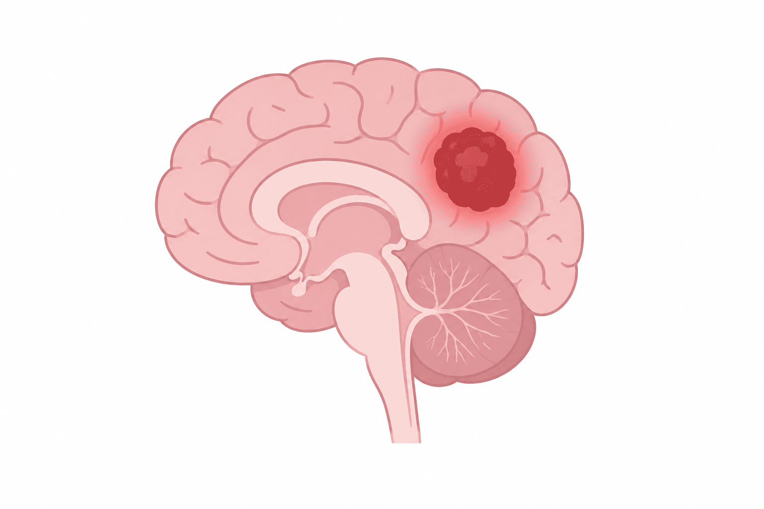 Best Brain Tumour in South Mumbai